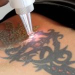 removing of tatoo